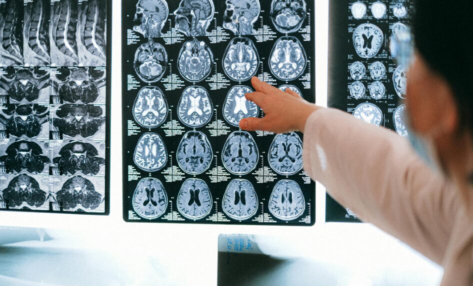 안면마비 구안와사 증상과 뇌졸중 감별 방법